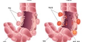 게실염 원인