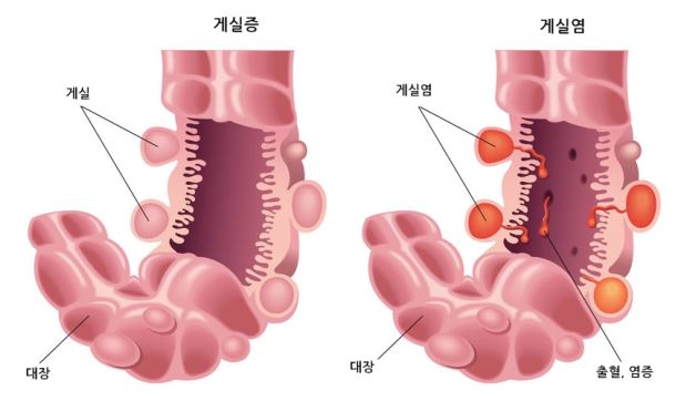 게실염 원인